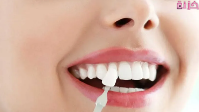 حلم سقوط الاسنان