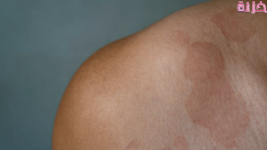 علاج التينيا نهائيا