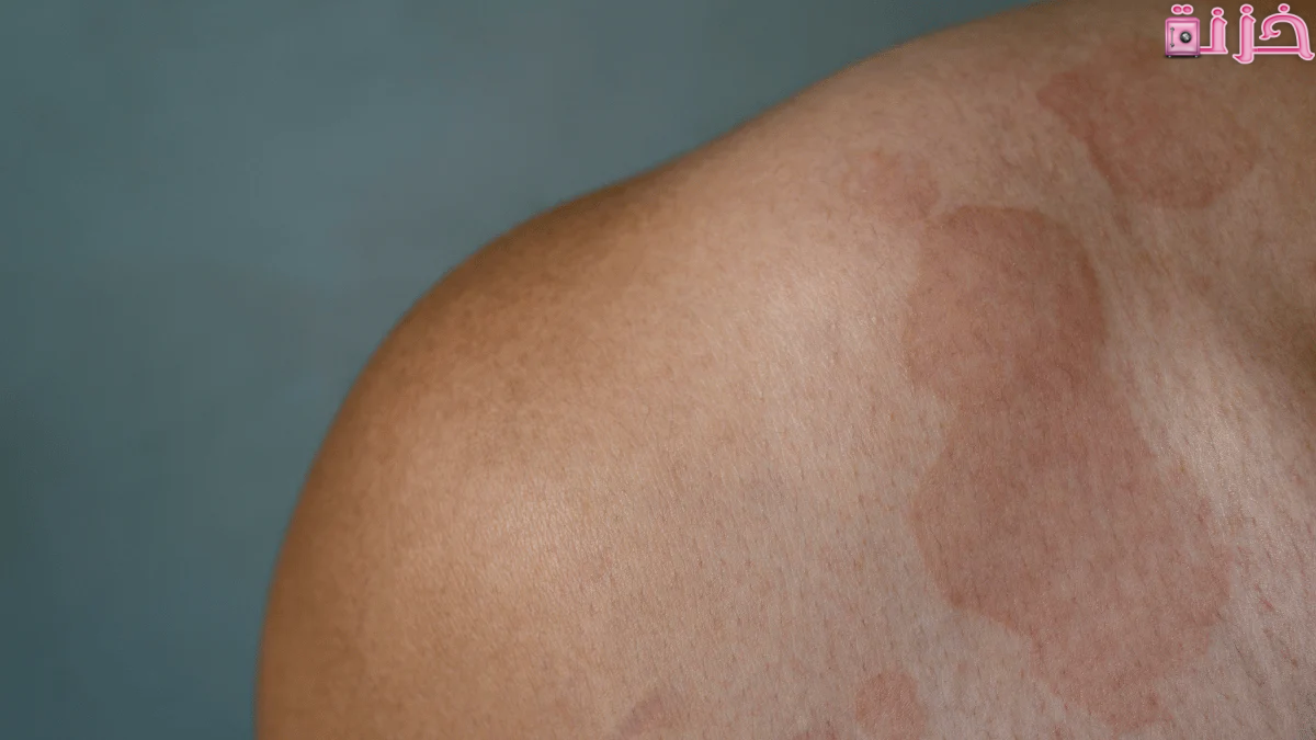 علاج التينيا نهائيا