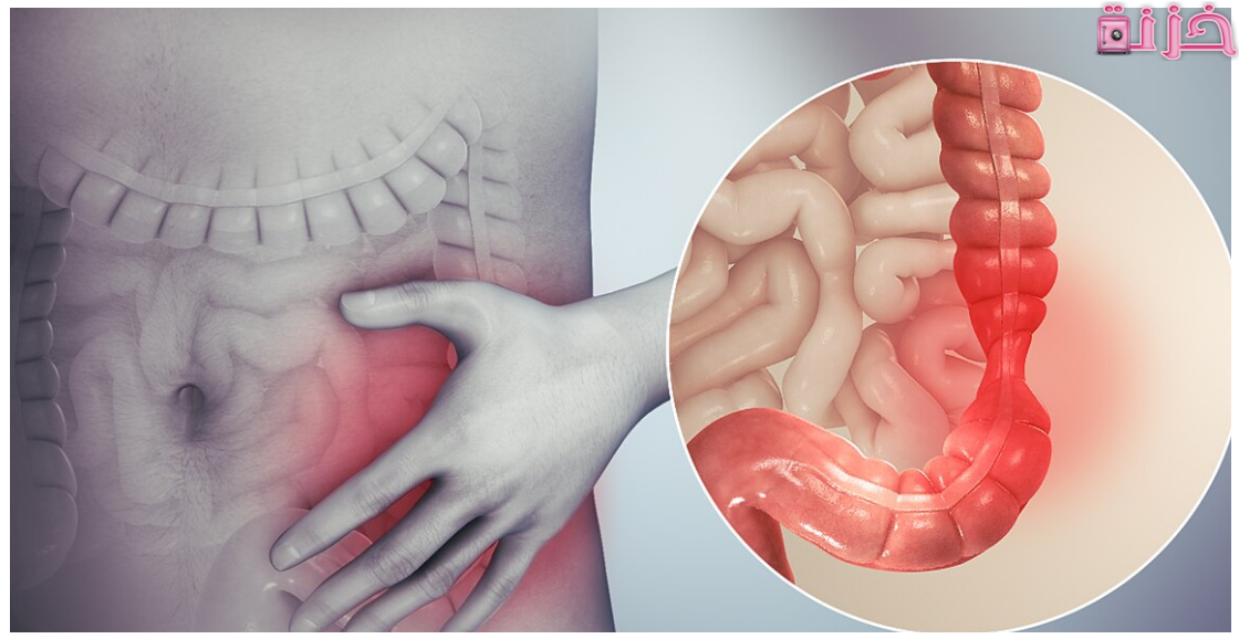 اعراض القولون العصبي
