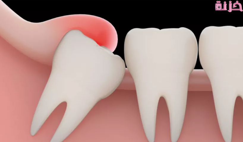 أعراض ألم ضرس العقل المدفون والمائل