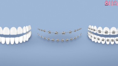 اسعار تقويم الاسنان في مصر