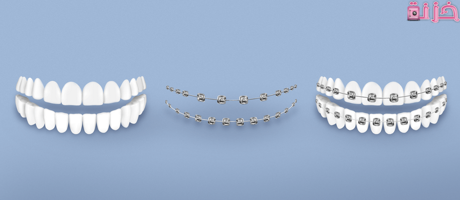اسعار تقويم الاسنان في مصر