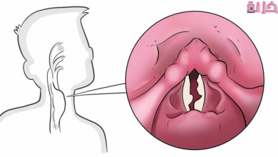 اسباب بحة الصوت ومتى تكون خطيرة