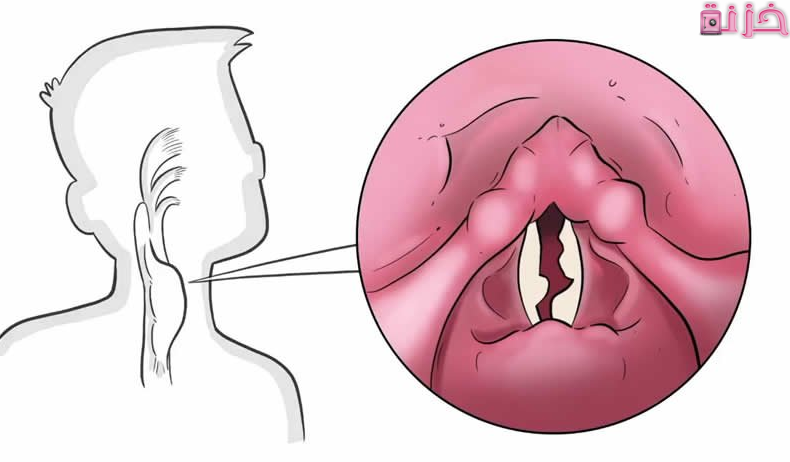 اسباب بحة الصوت ومتى تكون خطيرة