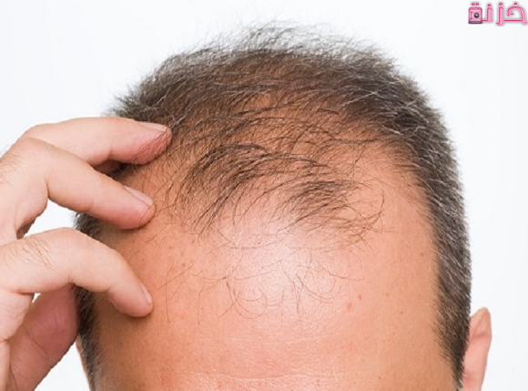 اسباب تساقط الشعر بكثرة من الجذور عند النساء والشباب