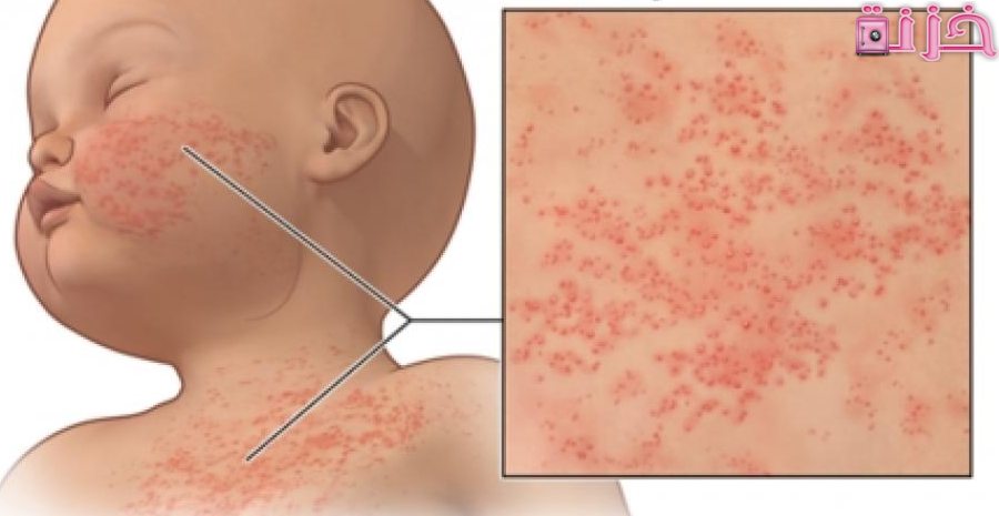 الفرق بين حمو النيل والحساسية عند الاطفال والكبار