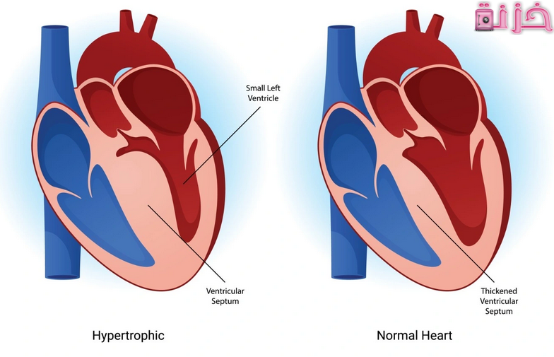 هل تضخم القلب يزول