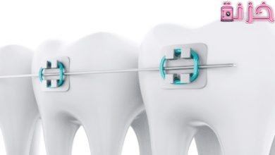 انواع و أسعار تقويم الاسنان في السعودية