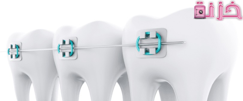 انواع و أسعار تقويم الاسنان في السعودية