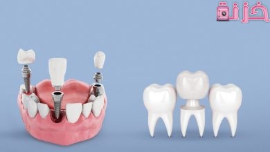 اسعار تركيبات الاسنان وانواعها