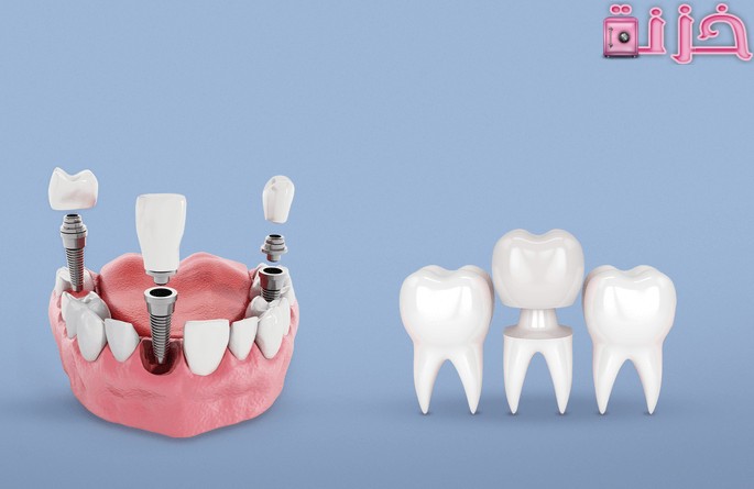 اسعار تركيبات الاسنان وانواعها