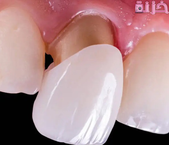 أسعار تلبيس الاسنان في مصر